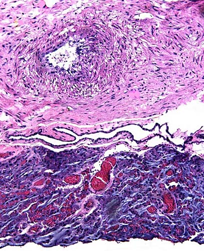 Compressed placental tissue beneath thick chorionic plate with large fetal vessel