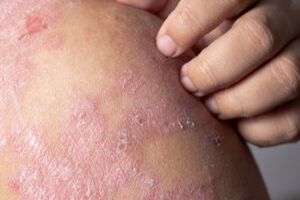 Tratamiento de la dermatitis atópica