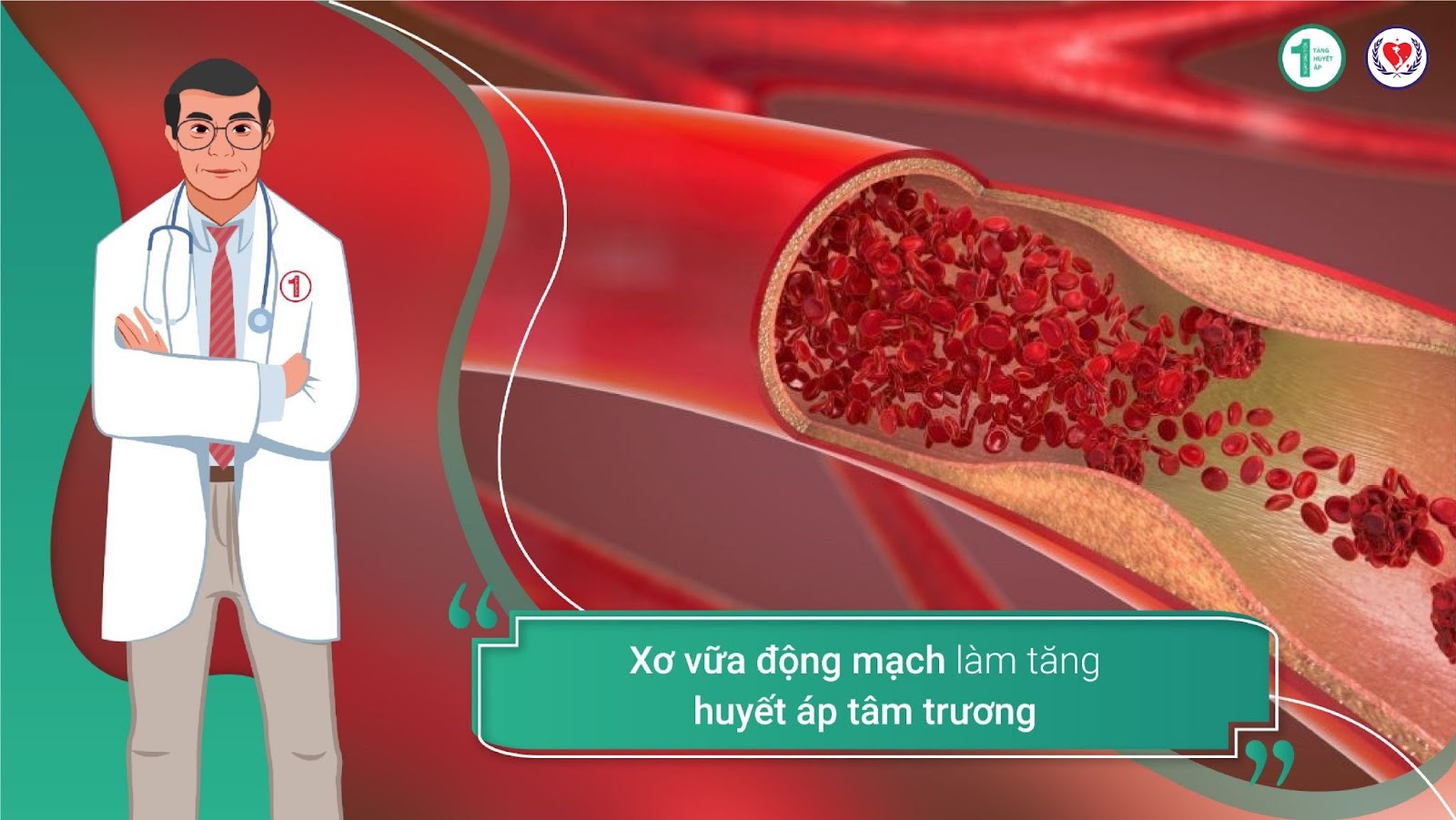 Huyết áp tâm thu, Huyết áp tâm trương và những điều bạn chưa biết về Tăng huyết áp? 