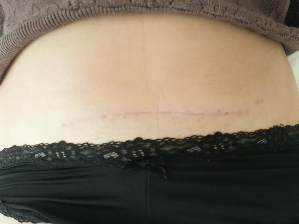 before after c-section scar 