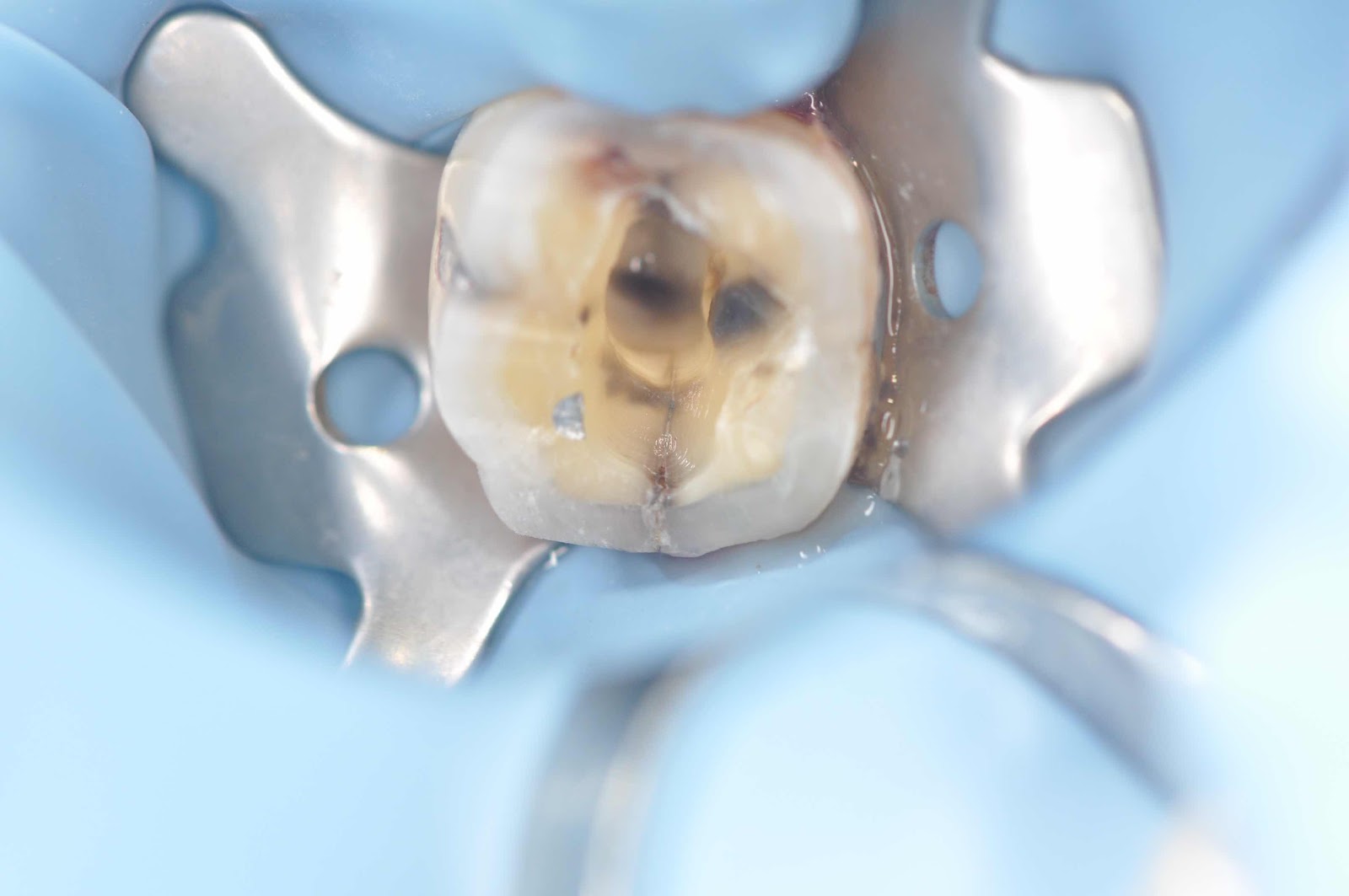 修磨後發現牙齒不完全牙齒斷裂