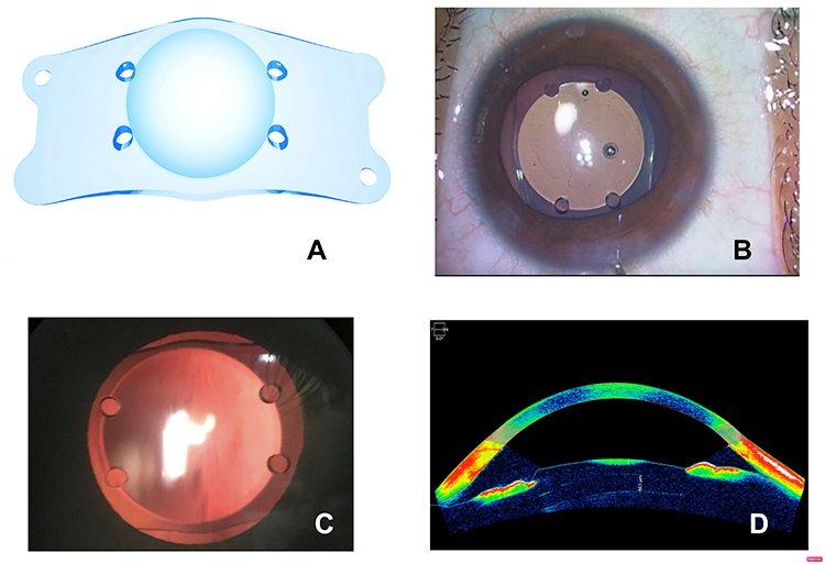 Safety and Efficacy of a New Posterior Chamber Phakic Intraocular Lens |  OPTH