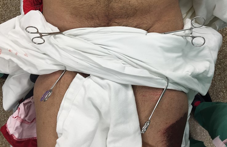 Estabilização externa com lençol - trauma pélvico