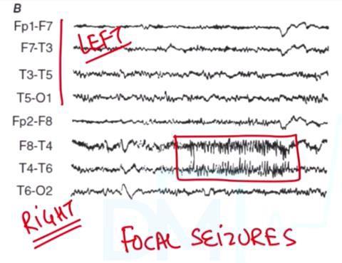 Focal seizure without intact awareness
