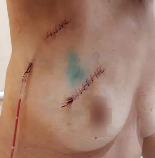 乳癌局切 放療比全切危險嗎 乳癌沒有全切會危險嗎 下集 蘇菲向前行 痞客邦