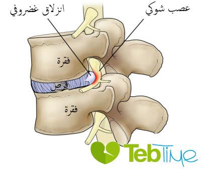 صورة توضيحية للانزلاق الغضروفي