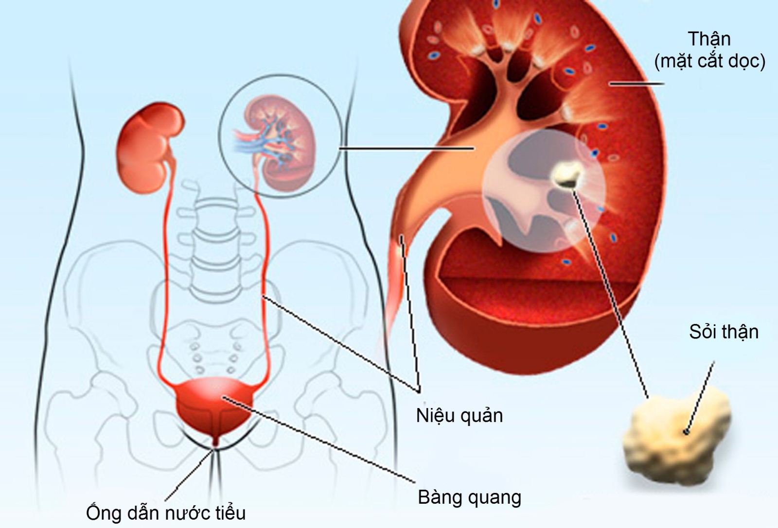 nguyên nhân sỏi thận