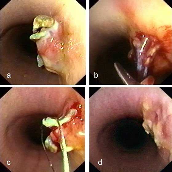 Transendoscopic removal of a penetrating laryngeal prosthesis (a) using scissors (b) and wiresnare (c), control endoscopy 8 days after surgery (d).