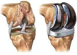 L'arthroplastie de genou : la prothèse totale du genou. - Centre de  Chirurgie Orthopédique et Sportive