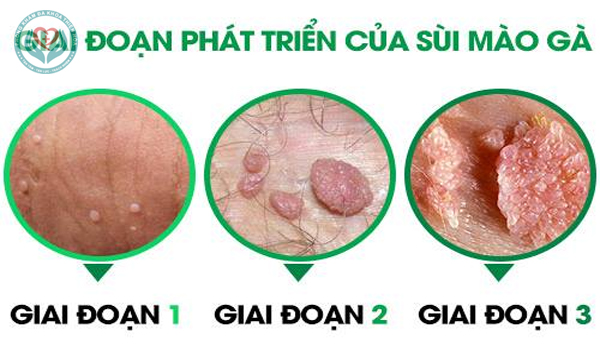 sùi mào gà giai đoạn đầu