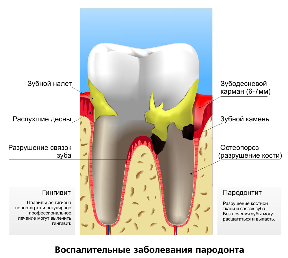 Заболевания зубов и полости
