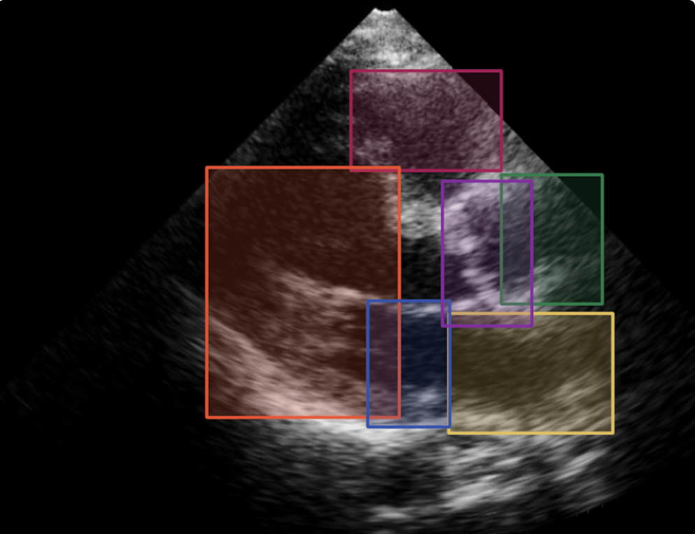 This ultrasound image has potentially cancerous cell clumps outlined in bounding boxes.