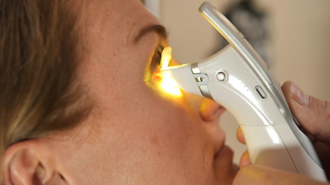 iLUX device utilizing thermal heat pulsation for meibomian gland dysfunction 