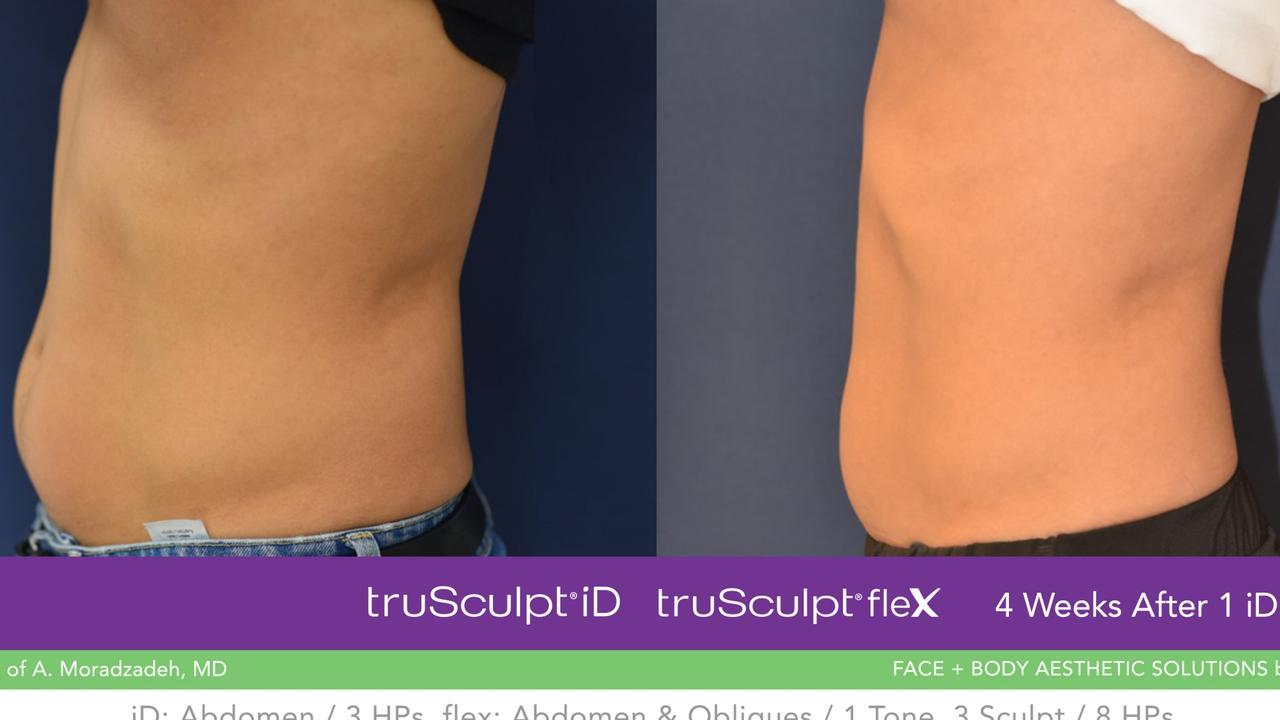 An example of a patient’s results achieved through the truBody treatments.
