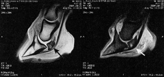 T1-weighted image on the left and STIR on the right show obvious navicular disease.