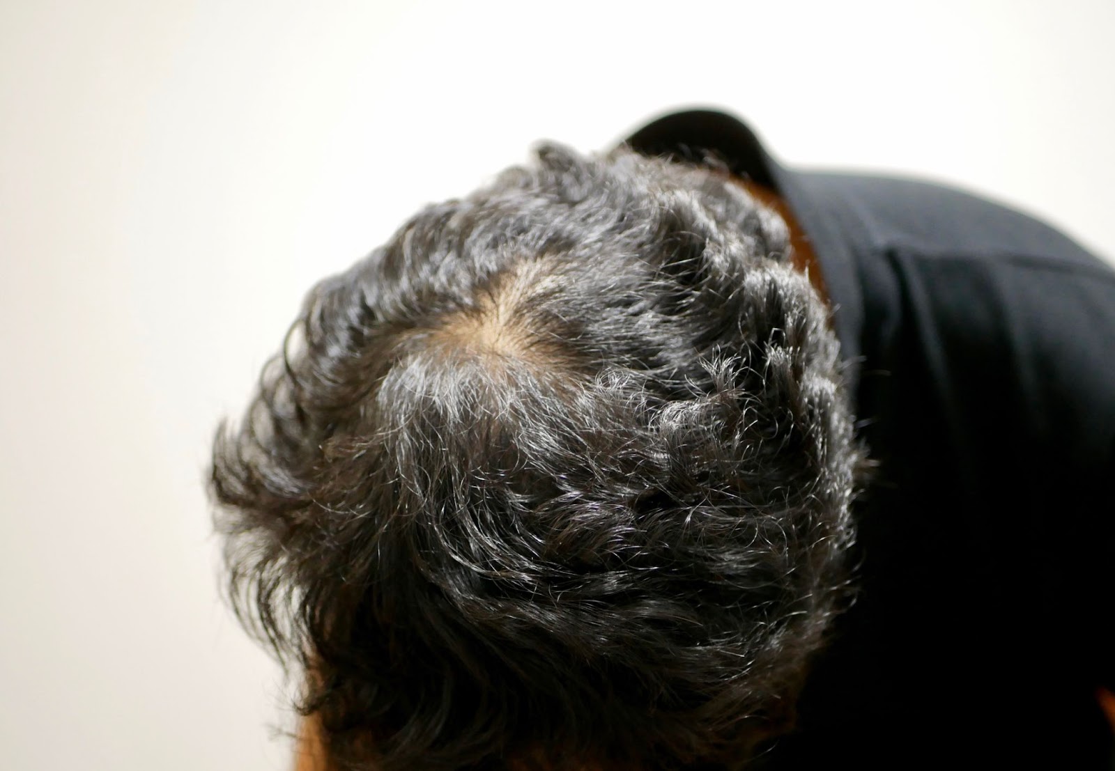 つむじ 頭頂部の薄毛5つの原因と対策 女性や10代の中学生 高校生もつむじハゲになる