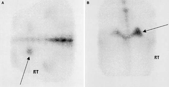 (A) Dorsal and (B) caudal delayed-phase scintigraphic images of a 2-yr-old Arabian with acute right hindlimb lameness and mild swelling and pain in the right caudal thigh region.