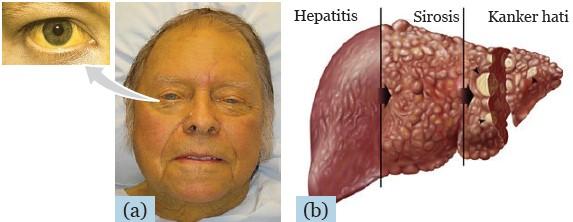 hepatitis - gangguan sistem pencernaan