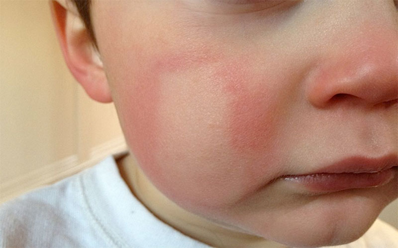 Алергія на холод на обличчі у дитини