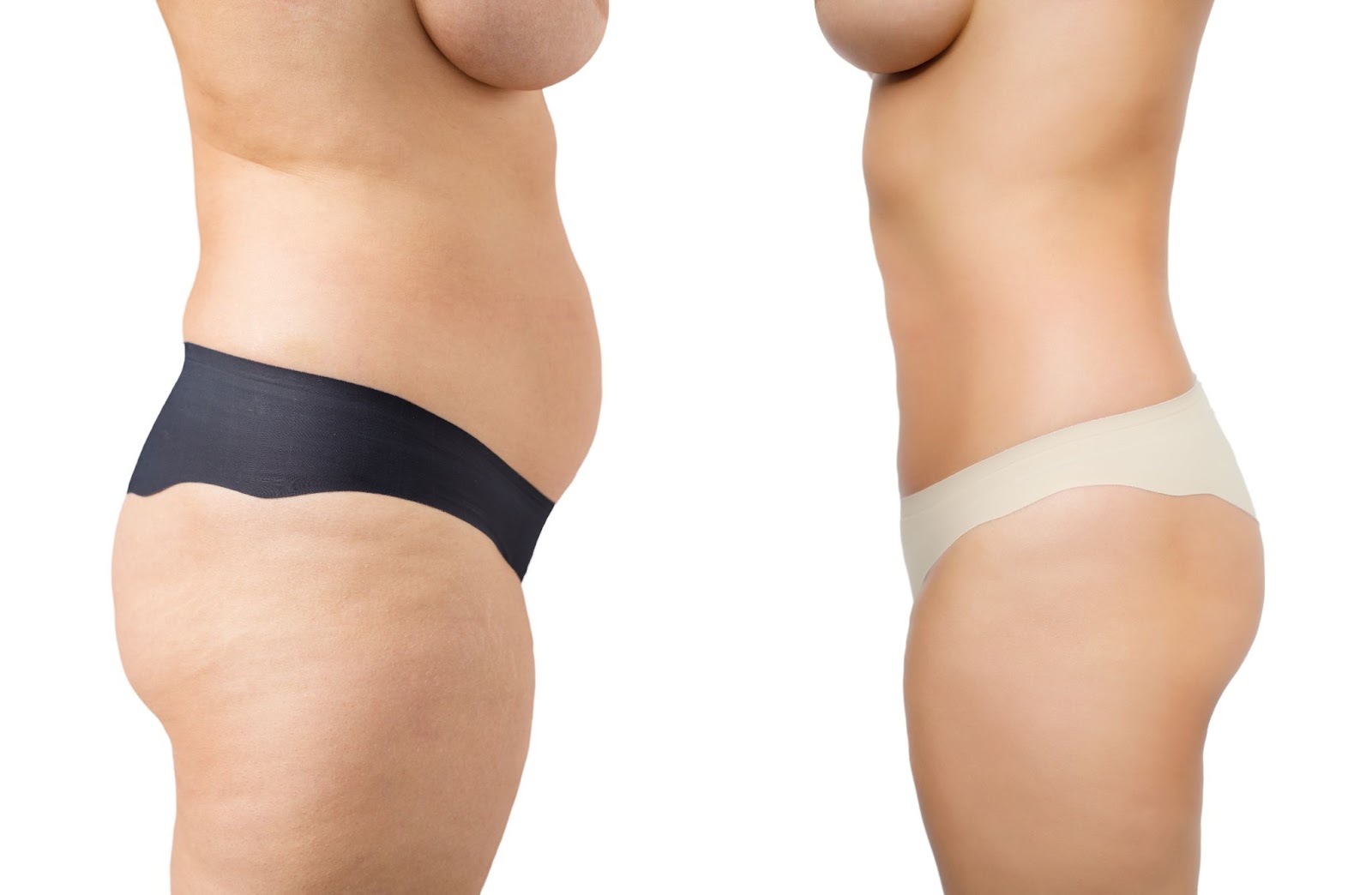 Patient 2 tummy tuck before and after 