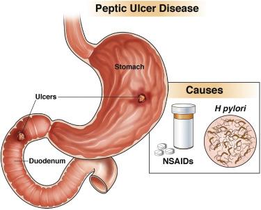 https://karnatakagastrocenter.com/new/peptic ulcer 2.jpg