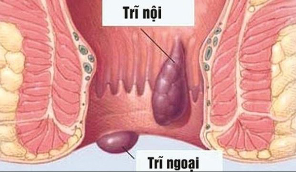 Bệnh trĩ ngoại có chữa được không