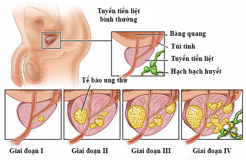 Giai đoạn phát triển của bệnh ung thư tuyến tiền liệt