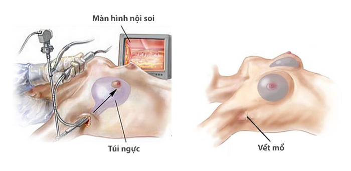 nâng ngực mất bao nhiêu thời gian? 