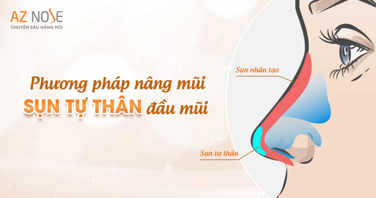 Thế nào là nâng mũi bằng sụn tự thân  Có nên thực hiện hay không