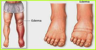 Relief from edema
