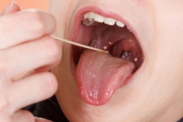 Bệnh đau rát họng là biểu hiện của nhiều loại bệnh khác nhau