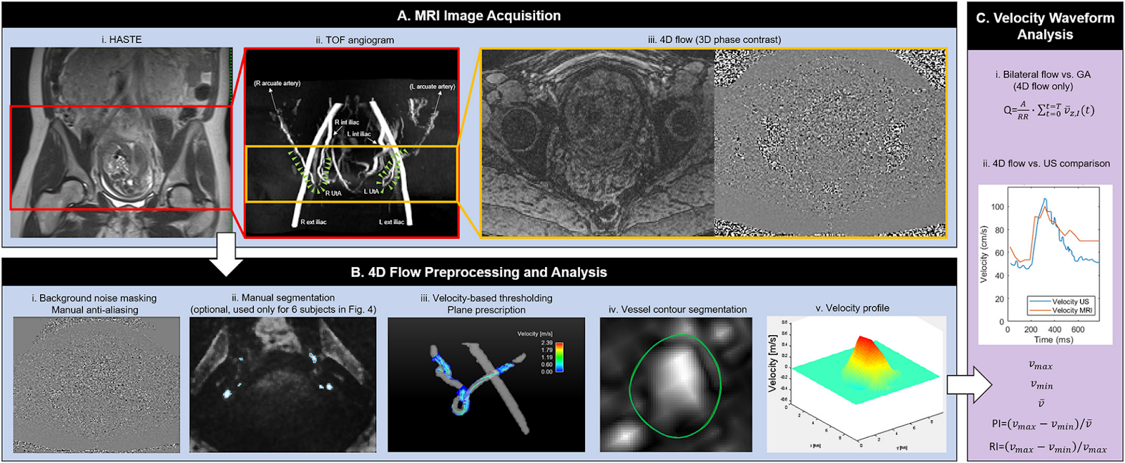 MRI acquisition, 4D flow processing, and velocity analysis in pregnant patients. Hwuang et al., J Magn Reson Imaging, 2019.