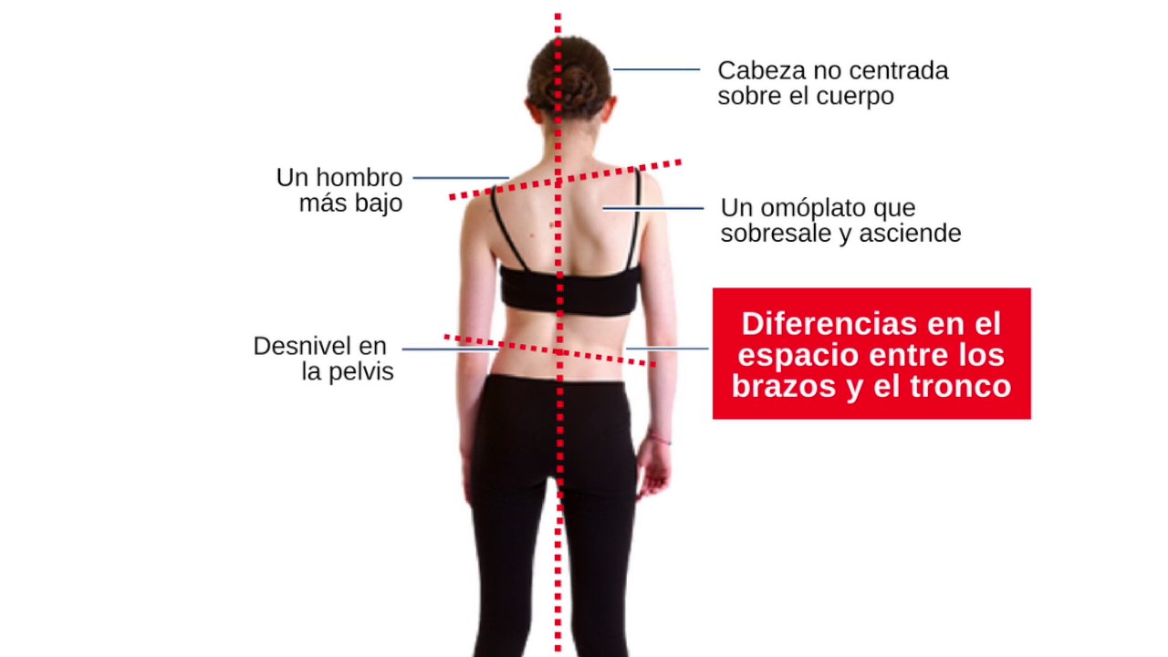 Masajes para escoliosis lumbar hotsell
