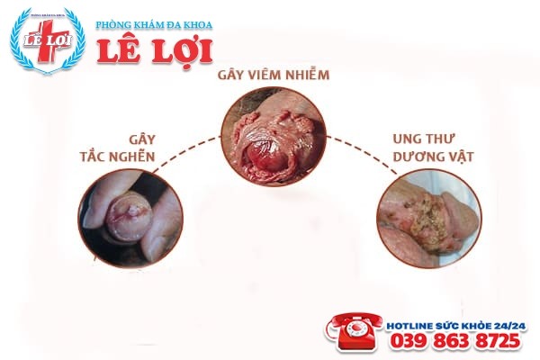 bệnh sùi mào gà ở nam giới