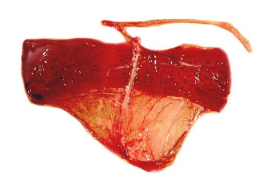Maternal aspect of the stillborn fetus' placenta
