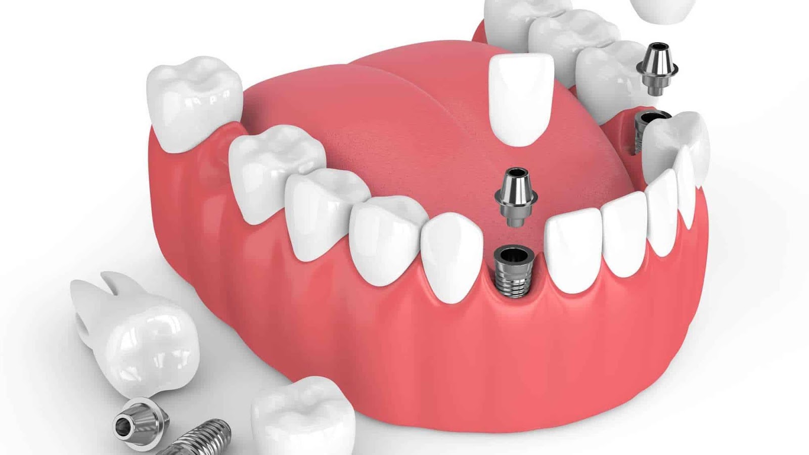 dental implants in Vancouver