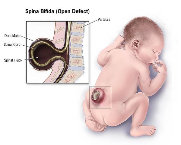 Spine bifida