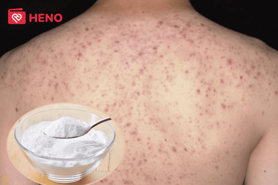 Baking soda có tính kiềm tự nhiên giúp điều chỉnh độ pH trên da và có tác dụng kháng khuẩn, giảm mụn lưng tại nhà