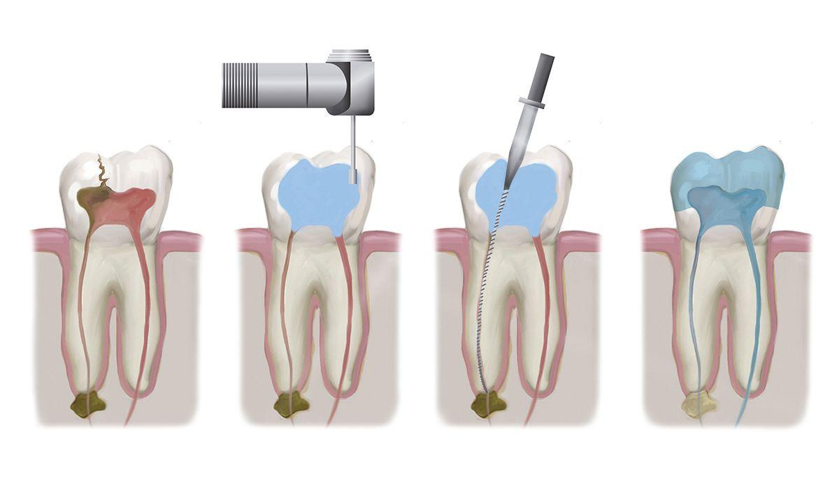 root canal therapy in Richmond Hill