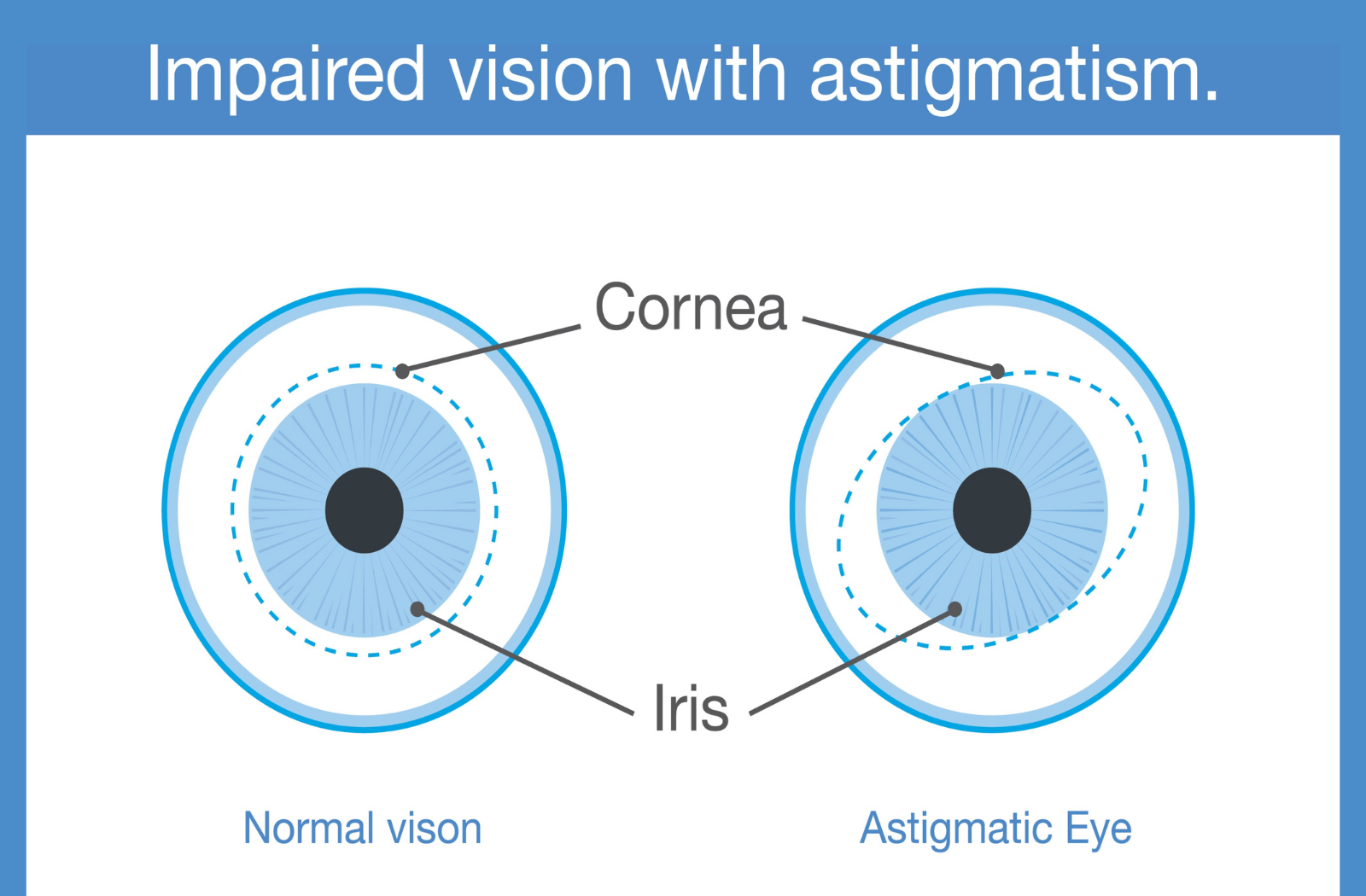 A graphic comparing a healthy eye's cornea and iris, compared to what an astigmatic eye looks like