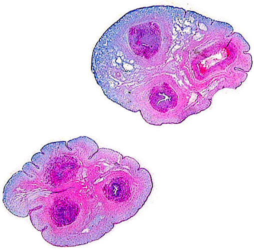Cross sections of umbilical cord. The vein in the top picture is at right. The bluish background is Wharton's jelly