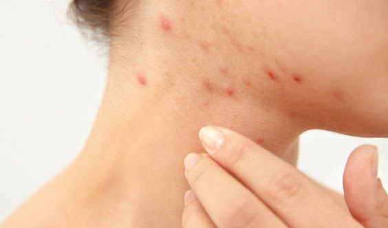 Neck acne solution at Da Vinci Clinic