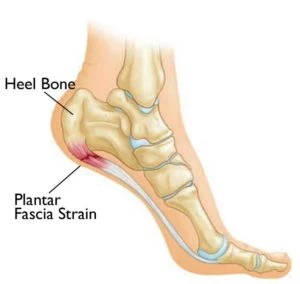 heel-pain1