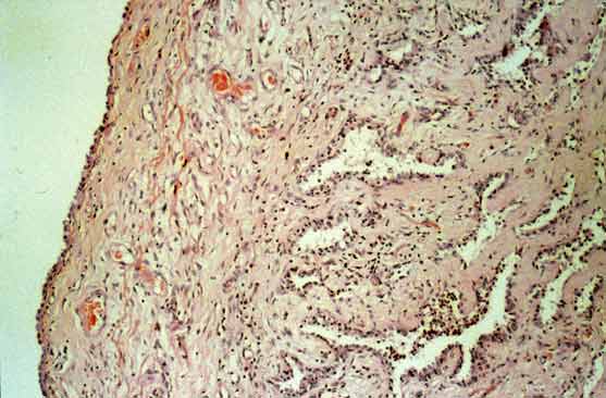 Subpleural fibrosis under high power.