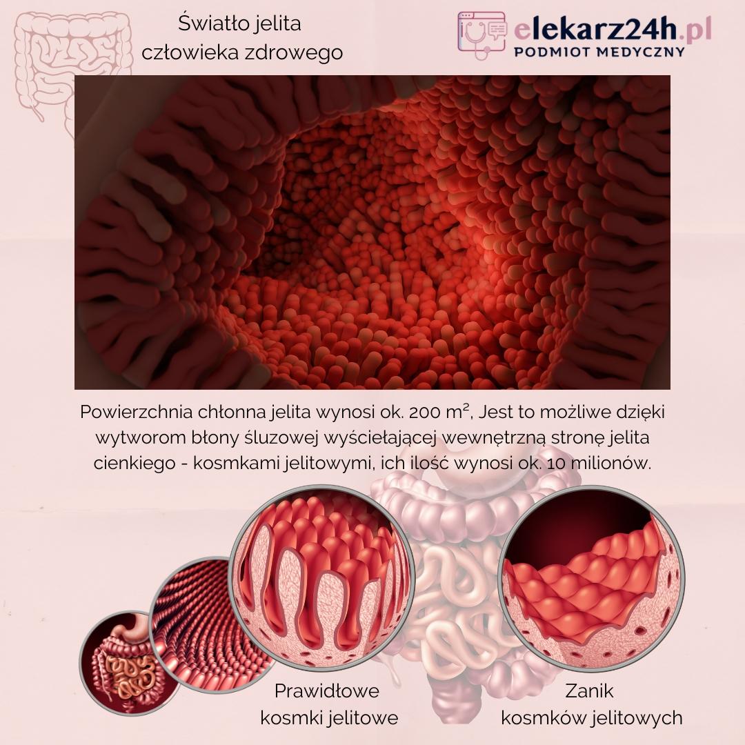 choroba duhringa jelito