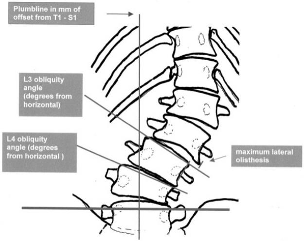 Spinal Joint instability | Posturetek - Subluxation remodeling systems