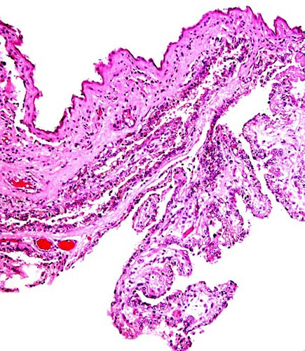 Fetal villous structures at the edge of the placental disk, covered by trophoblast